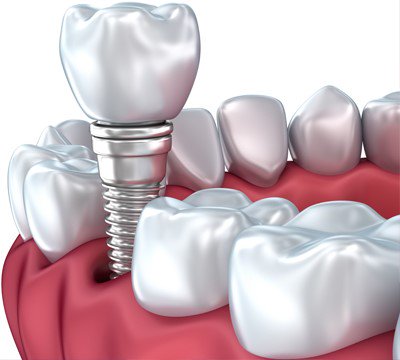 Imagem de um implante dentário